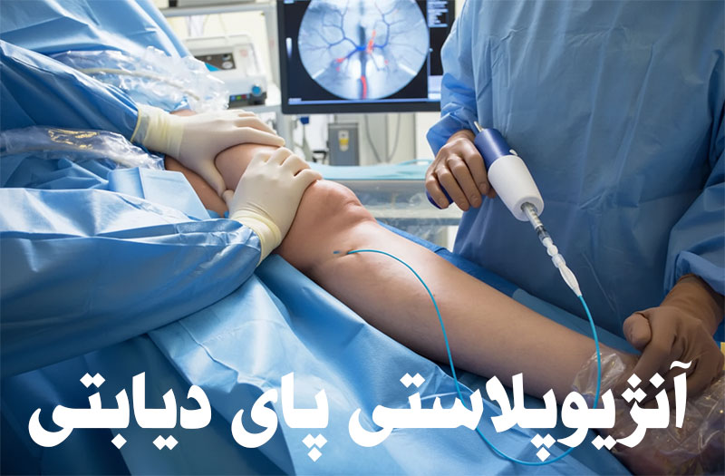 آنژیوپلاستی عروق پا