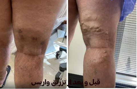 1قبل-و-بعد-واریس