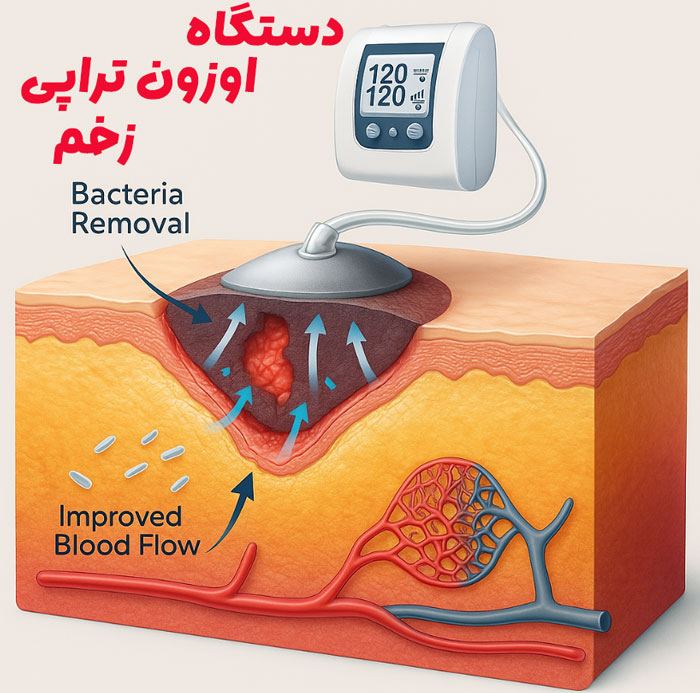 اوزون تراپی زخم