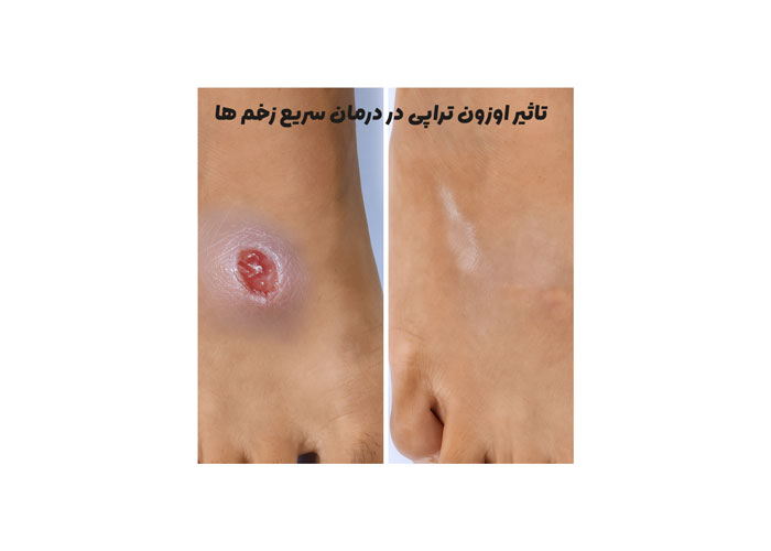نتایج موفق اوزون درمانی