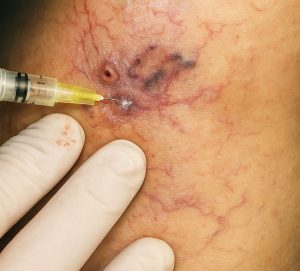 اسکلروتارپی-واریس تهران