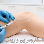 اسکلروتراپی-واریس