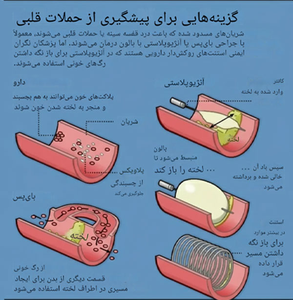 جراحی و استنت  جراحی و استنت