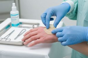 درمان زخم سوختگی