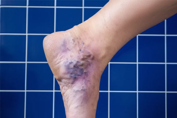 درمان زخم پای واریسی