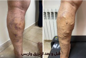 قبل-و-بعد-واریس