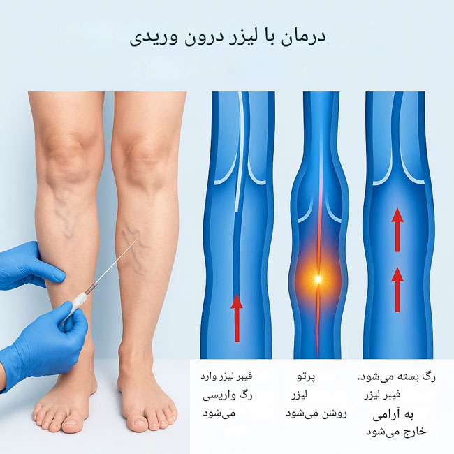 لیزرتراپی واریس پا لیزر واریس پا چیست و چگونه انجام می شود؟   لیزرتراپی واریس پا لیزر واریس پا چیست و چگونه انجام می شود؟