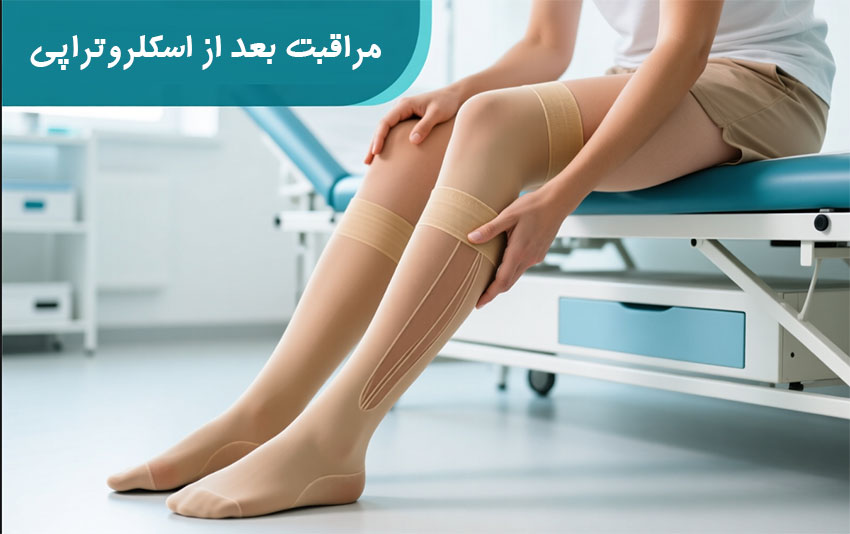 مراقبت‌های بعد از اسکلروتراپی