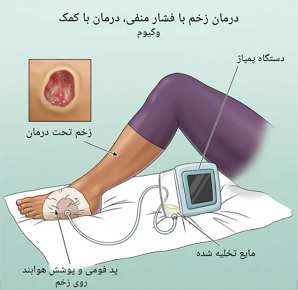 وکیوم تراپی زخم