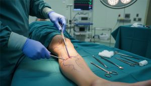 جراحی واریس