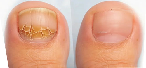 آشنایی با مشکلات رایج ناخن و راه های درمان آشنایی با مشکلات رایج ناخن و راه های درمان