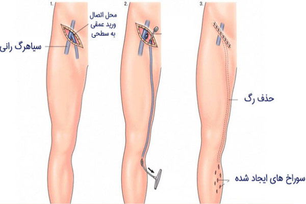 مراحل-عمل-فلبکتومی-واریس مراحل-عمل-فلبکتومی-واریس
