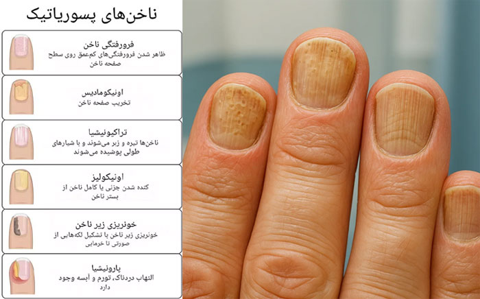 ناخن-های-پسوریاتیک ناخن-های-پسوریاتیک