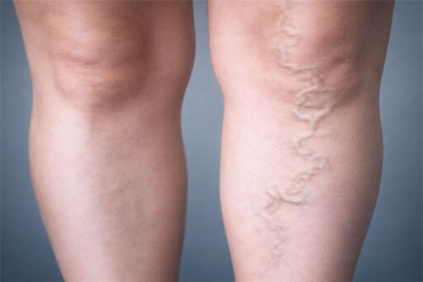 تفاوت علائم واریس و پلیسیتمی تفاوت علائم واریس و پلیسیتمی