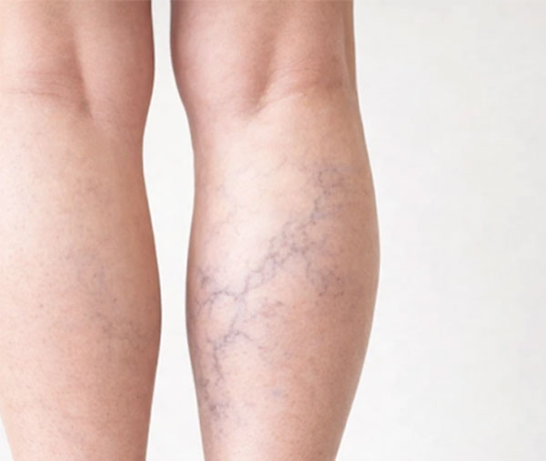 علائم مشترک واریس و پلیسیتمی جدول علائم مشترک واریس و پلیسیتمی