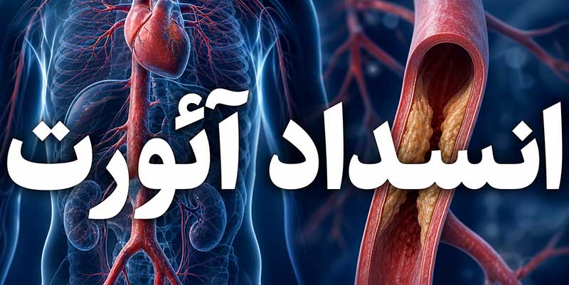 انسداد-آئورت انسداد آئورت
