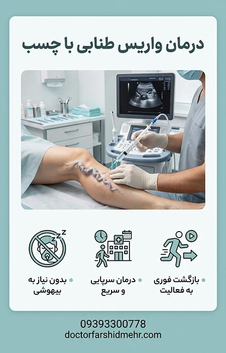 درمان واریس طنابی با چسب