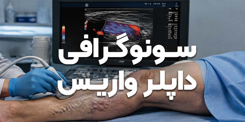 سونوگرافی داپلر واریس