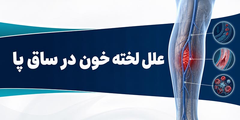 علل لخته خون در ساق پا
