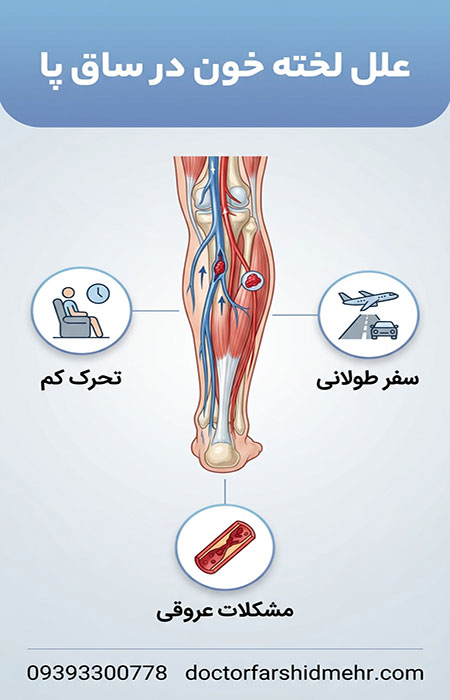 علل لخته خون در ساق پا