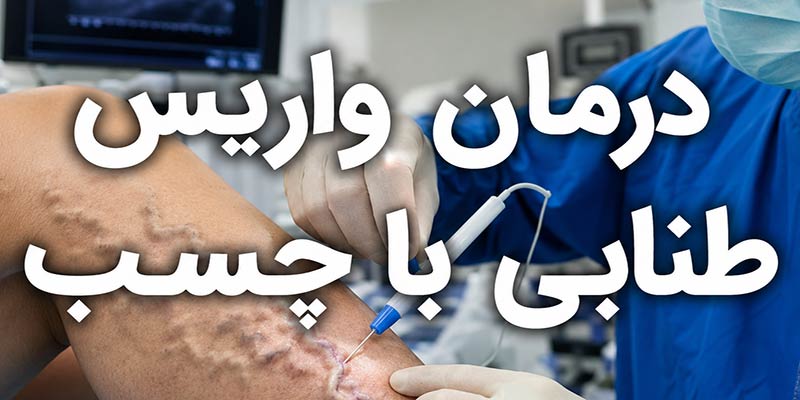 واریس طنابی با چسب