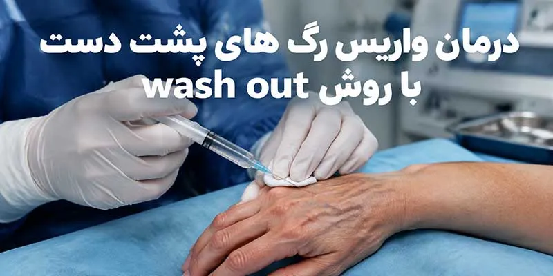 درمان واریس رگ های پشت دست با روش wash out