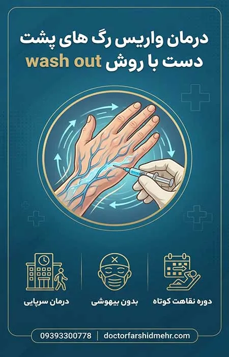 درمان واریس رگ های پشت دست با روش wash out