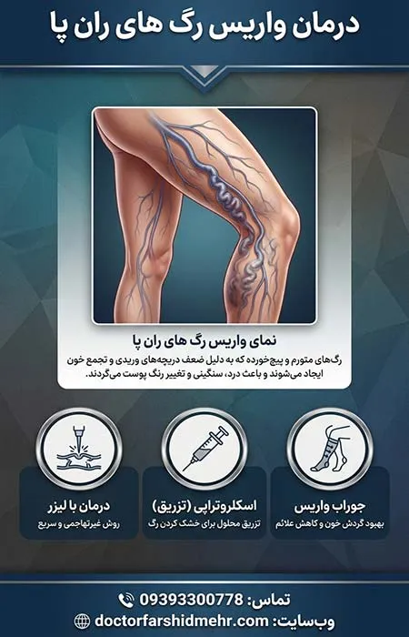 درمان واریس رگ های ران پا
