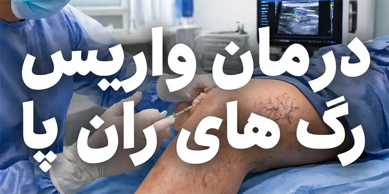 درمان واریس رگ های ران پا
